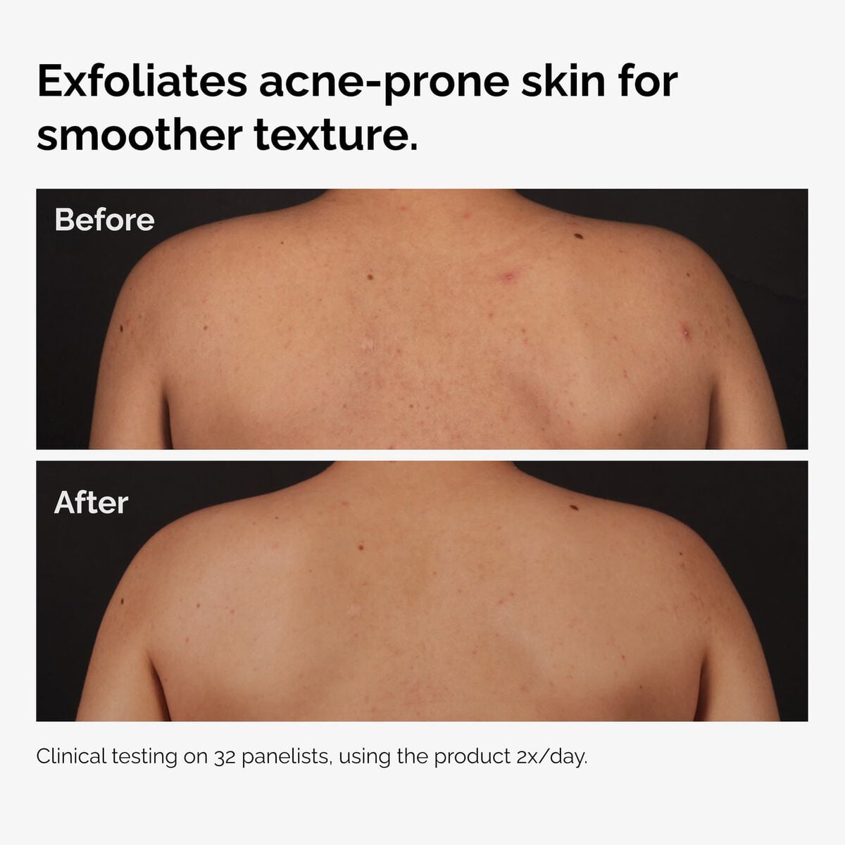 salicylic-acid-0-5-body-serum-d9 ord-salicylic-acid-body-serum-before-after-graphic-NA.jpg