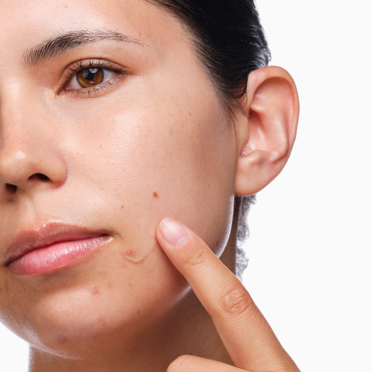 the-acne-set-n9 rdn-the-acne-set-application.png